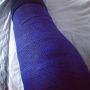 @erikth1 Niet goed 4u. Zo ziet been eruit. Kruisband is met bot van mijn scheenbeen afgerukt en nu weer vastgezet. 