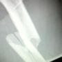 @tnacgal here is the X-ray of the break.