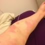 A very random rash has appeared up my arm…. #notgood 